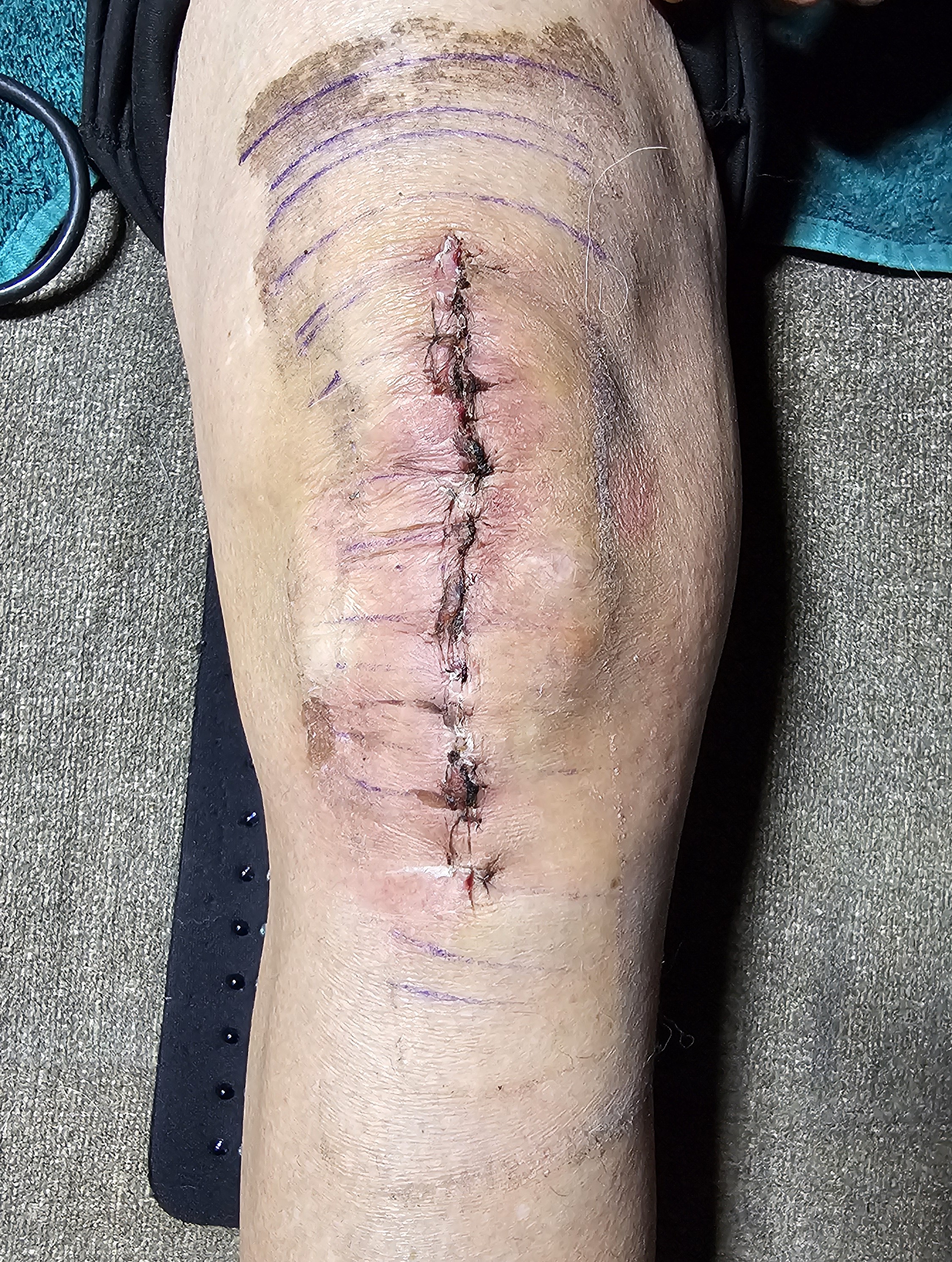 Knee Incision 2 weeks post surgery