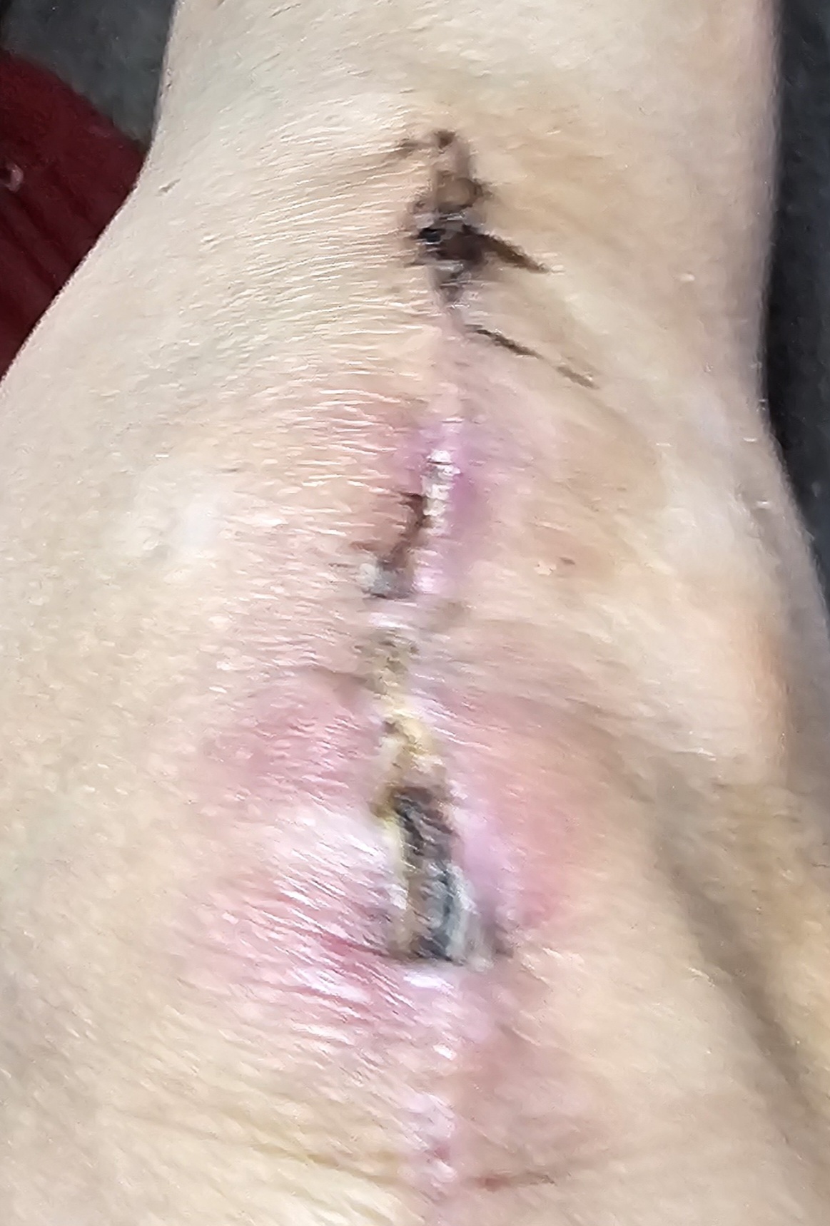 Post Knee Surgery
